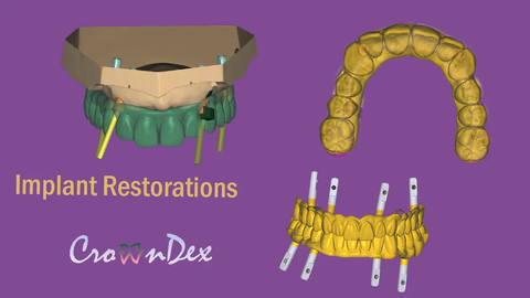 Professional CAD CAM Dental Design For Custom Prosthetic From Intraoral Scans Exocad Ready For 3D Printing And Milling