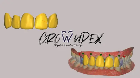 Professional CAD CAM Dental Design For Custom Prosthetic From Intraoral Scans Exocad Ready For 3D Printing And Milling