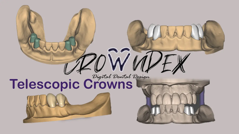 Professional CAD CAM Dental Design For Custom Prosthetic From Intraoral Scans Exocad Ready For 3D Printing And Milling