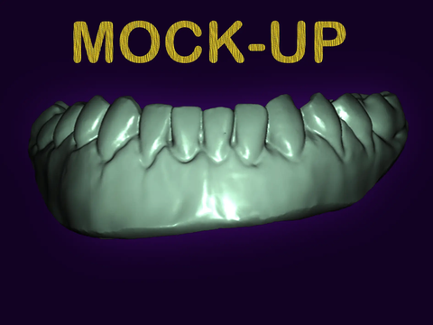Professional CAD CAM Dental Design For Custom Prosthetic From Intraoral Scans Exocad Ready For 3D Printing And Milling