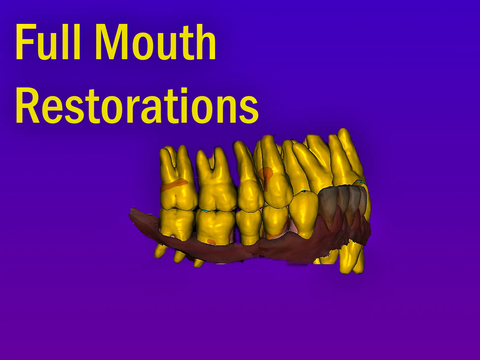 Professional CAD CAM Dental Design For Custom Prosthetic From Intraoral Scans Exocad Ready For 3D Printing And Milling