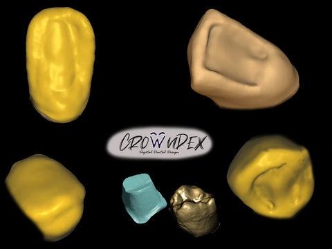 Professional CAD CAM Dental Design For Custom Prosthetic From Intraoral Scans Exocad Ready For 3D Printing And Milling
