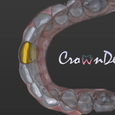 Professional CAD CAM Dental Design For Custom Prosthetic From Intraoral Scans Exocad Ready For 3D Printing And Milling