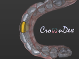 Professional CAD CAM Dental Design For Custom Prosthetic From Intraoral Scans Exocad Ready For 3D Printing And Milling