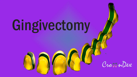 Professional CAD CAM Dental Design For Custom Prosthetic From Intraoral Scans Exocad Ready For 3D Printing And Milling