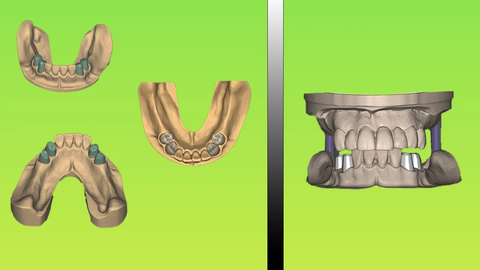 Dental Model Prototyping